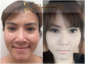 ยุบโหนกแก้ม