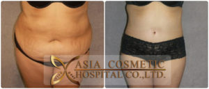 ดูดไขมัน