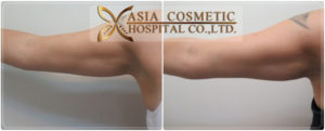 ดูดไขมันต้นแขน