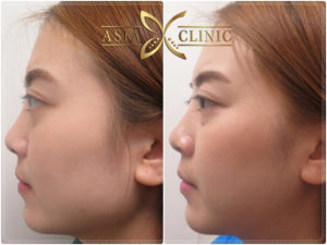 ตัดกราม รีวิว