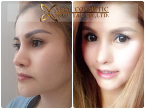 ตัดกราม แก้ไขคาง