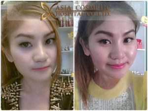 ตัดปีกจมูก รีวิว