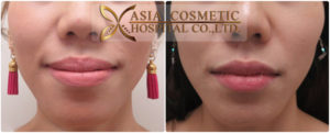 ทำคาง chin augmentation