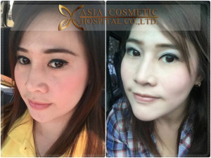 ทำคาง โรงพยาบาลเอเซีย