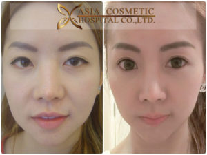 ทำคางที่ไหนดี