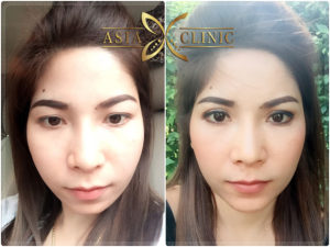 ทำคางที่ไหนสวย