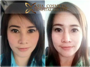 ทำคางโรงพยาบาลเอเซีย