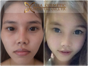 ยุบโหนก ลดโหนกแก้ม