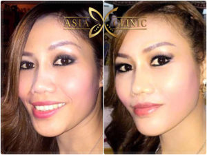 รีวิว เสริมคาง