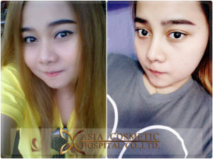 รีวิว เสริมจมูก 7 เดือน