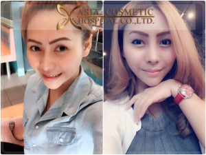 รีวิว เสริมจมูก1เดือน