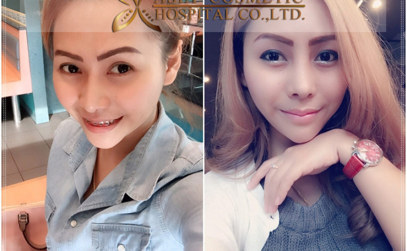 รีวิว เสริมจมูก1เดือน