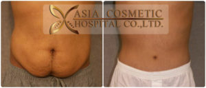 รีวิวดูดไขมันหน้าท้อง