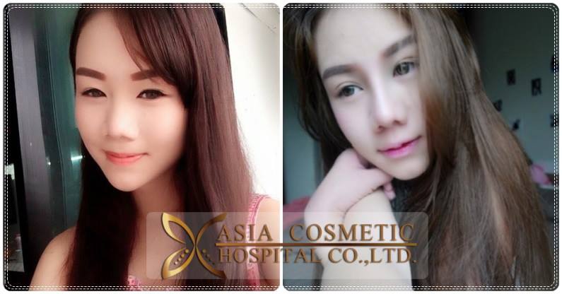 รีวิวทำดั้ง