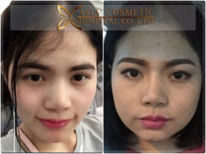 รีวิวผ่าตัดกราม