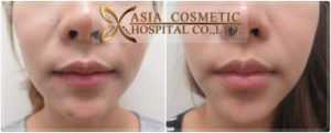 รีวิวผ่าตัดเสริมคาง