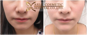 รีวิวผ่าตัดเสริมคางที่โรงพยาบาลเอเซีย