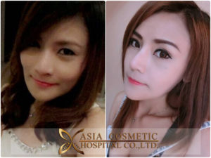 รีวิวลดโหนกแก้ม