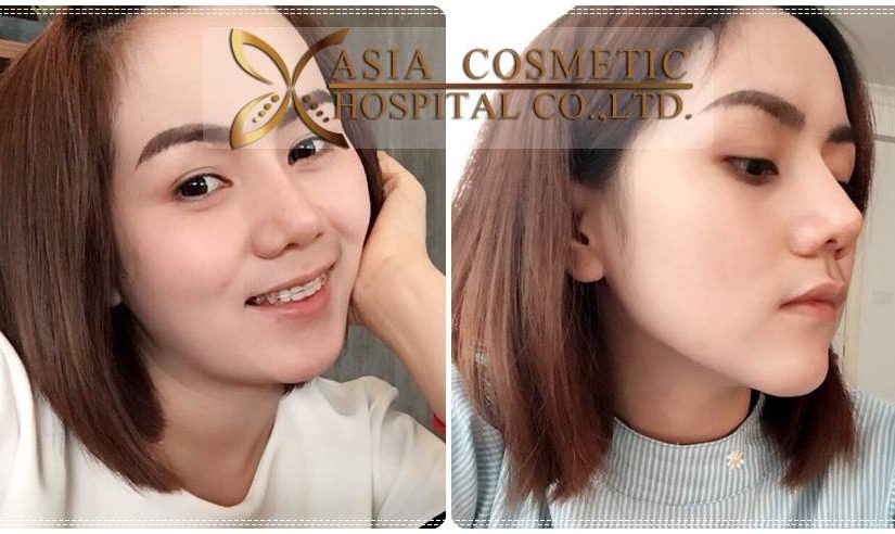 เสริมคาง