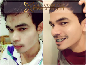 รีวิวหลังเสริมจมูก9เดือน