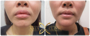 รีวิวเสริมคางที่โรงพยาบาลเอเซีย