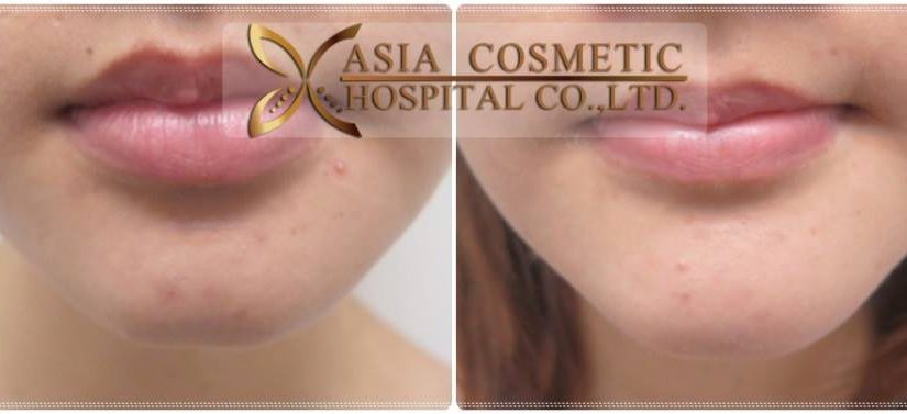 รีวิวเสริมคางสวย