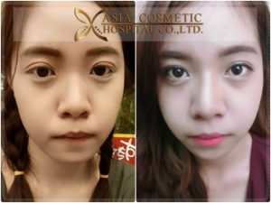 รีวิวเสริมจมูก โรงพยาบาลเอเซีย