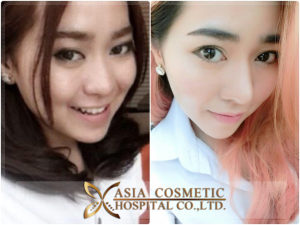 รีวิวโรงพยาบาลเอเซีย เสริมจมูก