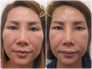 ลดโหนกแก้ม