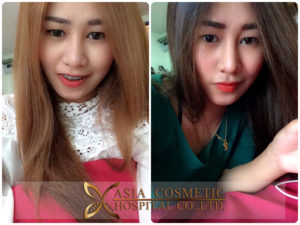 ศัลยกรรมคาง