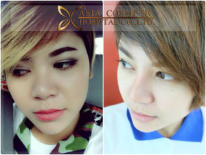 หลังเสริมจมูก 3เดือน