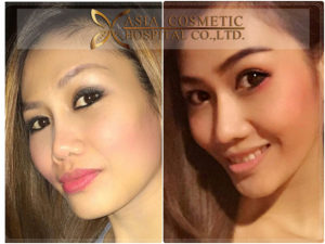 เสริมคาง