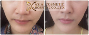 เสริมคาง chin augmentation