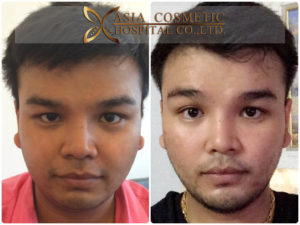 เสริมคาง ผู้ชาย