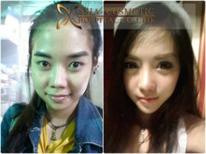 เสริมคาง โรงพยาบาลเอเซีย