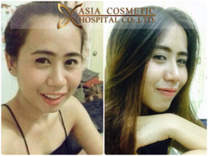 เสริมคางที่ไหนดี