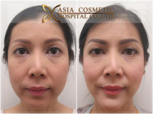 เสริมคางสวย