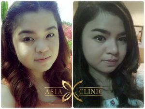 เสริมจมูก