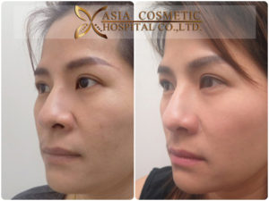 เสริมจมูก ตัดปีก