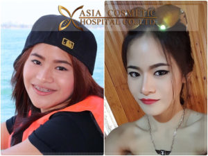 เสริมจมูก ตัดปีกจมูก