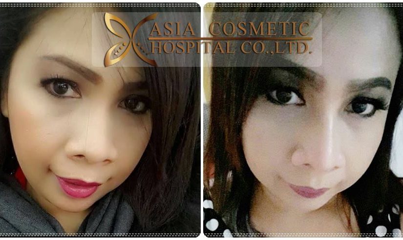 รีวิวเสริมจมูก