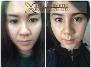 เสริมจมูกสวยธรรมชาติ