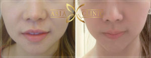โรงพยาบาลเอเซีย chin augmentation