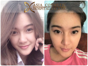 โรงพยาบาลเอเซีย รีวิวเสริมจมูก