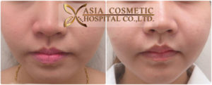โรงพยาบาลเอเซียเสริมคางสวย