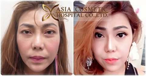 การศัลยกรรมตาสองชั้น