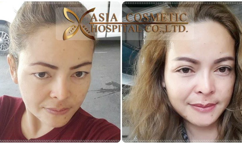 ทำตา2ชั้น