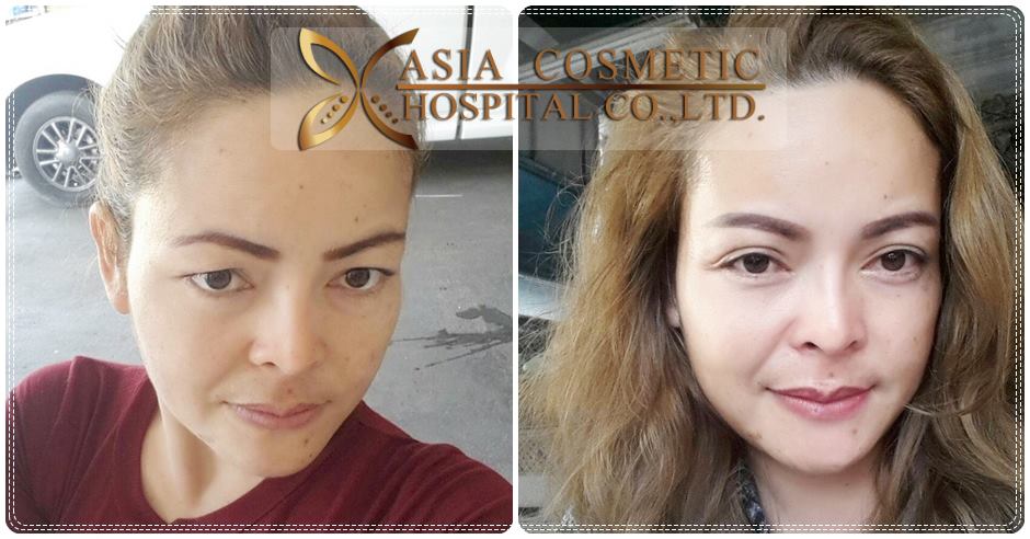 ทำตา2ชั้น