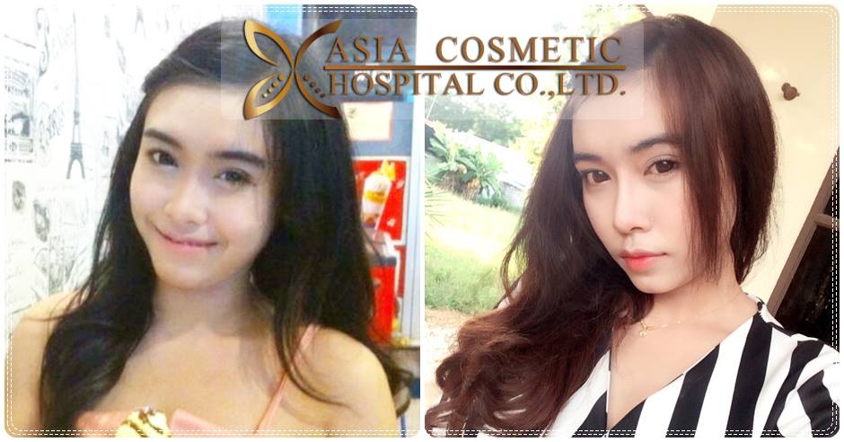 ประสบการณ์เสริมจมูก