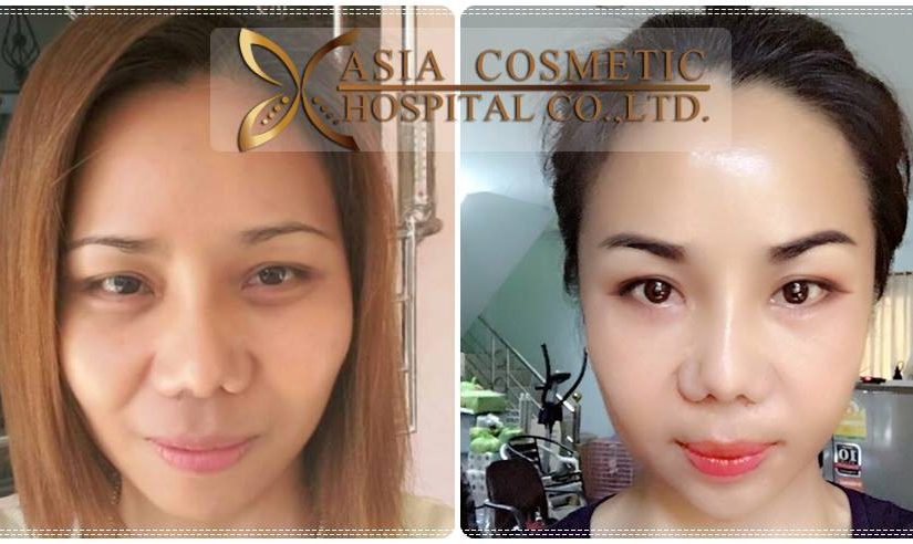 ผ่าตัดยุบโหนกแก้ม